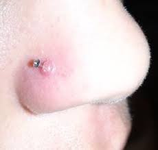 Nose Piercing Bump New Health Guide Nose Piercing Bump Piercing Bump Nose Piercing