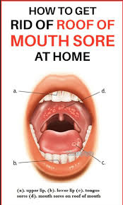 Bruises develop when capillaries burst after an impact, while blood clots occur when an injury damages blood vessels. Why Does The Roof Of My Mouth Hurts When I Eat