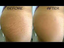 Bio Oil Stretch Marks Before And After Top 6 Ways To Get Rid Of Stretch Marks Show Viral Stretch Marks Oil Skin Care Routine Bio Oil Stretch Marks