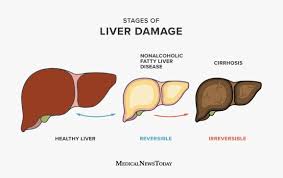 Liver cancer is when a malignant tumor starts in or on the liver. Fatty Liver Disease Symptoms Causes Risks And Treatment