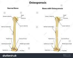 Maybe you would like to learn more about one of these? Osteoporosis Labeled Diagram Humerus Bone Royalty Free Stock Vector 181150889 Avopix Com
