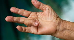 Keeping it elevated will help reduce it. Trigger Finger Treatment Without Surgery Norton Healthcare Louisville Ky