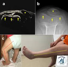 Image result for Patellar Dislocation