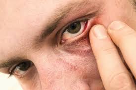 Gejala blepharospasm yang perlu diwaspadai, antara lain yakni: 8 Penyebab Mata Kedutan Dari Sisi Medis Banyak Orang Yang Belum Tahu
