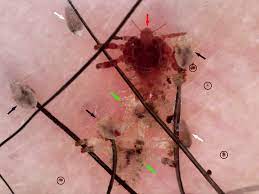 Think of your bush as protective pillow. White Eggs And Yellow Brown Spots On The Pubic Perineal Hairs The Bmj