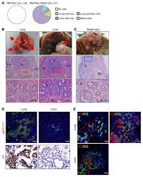 To assess the clinical characteristics and outcome of patients with liver metastases in prostate carcinoma. Jci Notch Promotes Tumor Metastasis In A Prostate Specific Pten Null Mouse Model