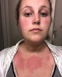 Any short-term natural solutions for sores