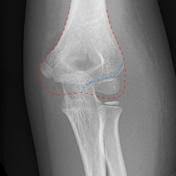 Image result for Lateral Condyle Fracture