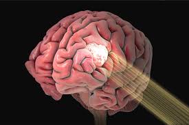 Image result for Intensity-Modulated Radiation Therapy