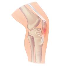 Patellar Tendinitis Wikipedia
