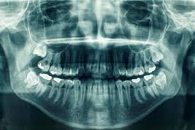 How Strong Are Your Teeth Dental X Ray Dental Hygenist
