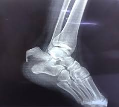 Image result for Calcaneal Apophysitis
