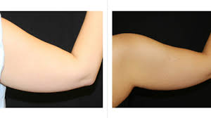 Coolsculpting is an option for removing stubborn fat in the upper arms. Laser Lipo Vs Coolsculpting