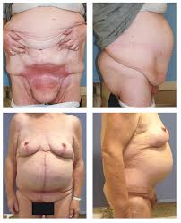 Gastric bypass surgery before and after pictures gastric bypass before and after photos are an amazing way to showoff success after undergoing surgery. Plastic Surgery After Bariatric Surgery Tidsskrift For Den Norske Legeforening