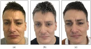 Efficacy of 1064 nm Photobiomodulation Dosimetry Delivered with a  Collimated Flat-Top Handpiece in the Management of Peripheral Facial  Paralysis in Patients Unresponsive to Standard Treatment Care: A Case Series