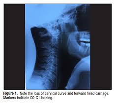 Undiagnosed Atlas Subluxation In Patient With Pain And Poor Myofascial Function