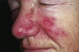 We did not find results for: Rosacea Wikipedia