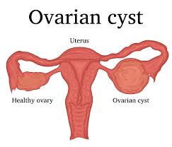 Nov 22, 2019 · complete pelvic ultrasound (upeltv) this is a complete pelvic ultrasound exam, including transabdominal and transvaginal. Ovarian Cyst Causes And Symptoms Apollo Hospitals Blog