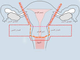 اعراض الرحم ا طريقة جديدة أسرع وأدق وأقل كلفة لاكتشاف سرطان عنق الرحم