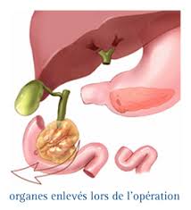 Pancreatic cancer is aggressive with few symptoms until the cancer is advanced. Infocancer Arcagy Gineco Localisations Appareil Digestif Cancer Du Pancreas Traitements La Chirurgie