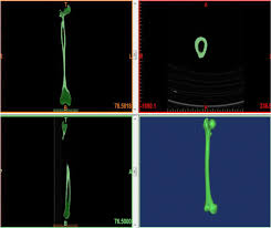 3, 4 a third type of ossification that occurs when osteoblasts line the. An Anisotropic Analysis Of Human Femur Bone With Walking Posture Experimental And Numerical Analysis Springerlink