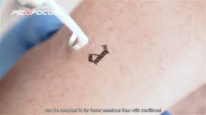 Need to remove or fade a tattoo? Picofocus New Era Of Laser Tattoo Removal Technology Youtube