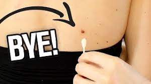 Freezing Off My Nasty Moles Diy Moles Removal At Home Youtube