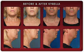The dermatologist in torrance, ca, michael the average cost of kybella treatment is $1200 to $1800 per session. Treatment Of The Double Chin Surgical Non Surgical Options