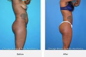 Find out all the factors that play into what you can expect to pay. How Much Does Brazilian Butt Lift Surgery Cost In Chicago Illinois Chicago Breast Body Aesthetics