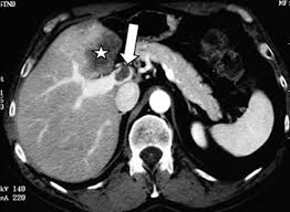 Thrombose Portale Tumorale Et Metastase Hepatique De Cancer Colorectal Une Association Peu Connue Sciencedirect
