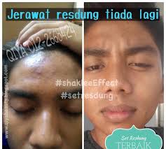 Jika dipencet, maka akan muncul bekas yang sulit dinormalkan kembali. 6 Maksud Jerawat Berdasarkan Kedudukan Di Muka Penyebab Serta Cara Mengatasinya Qiya Beauty