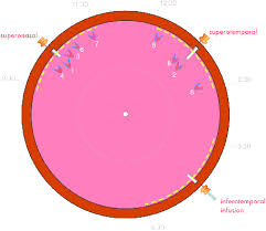 Fundus Map Of 23 Gauge Vitrectomy Sclerotomy Related Breaks