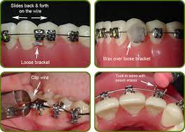 While You Are On Vacation Or At School You May Have An Issue With A Broken Bracket Or Wire You Can Use Wax To Co Orthodontics Dentistry For Kids Dental Braces