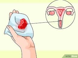 Mar 12, 2020 · cervical cancer normally doesn't manifest itself at early stages, so a woman doesn't feel any different. How To Recognize Cervical Cancer Symptoms 12 Steps