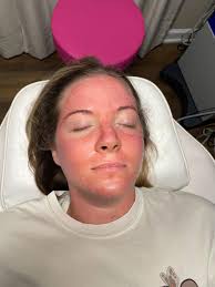 Microneedling glow facial special in Franklin