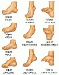 Image result for Clubfoot