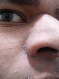 Skin Concerns Every Time After Showering I Get These White Things Around My Nose What Are They In 2020 Skin Concern Skin Nose