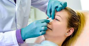 Nasal polyps are not cancer. Nose Splints How They Work What To Expect And More