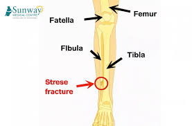 Image result for Tibia Stress Fracture