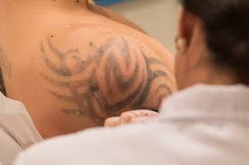 Lasers are the safest and most effective way to remove tattoos and avoid scarring. Tattoo Removal Creams Why You Should Never Use Them Precision Laser Tattoo Removal