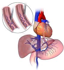 Sclerotherapy Wikipedia