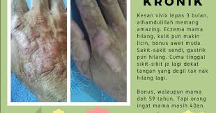 Kulit semakin cerah dan kering setelah datang untuk. Klinik Pakar Kulit Eczema Shah Alam