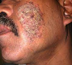 Pemphigus vulgaris presenting as an isolated crusted plaque of the cheek