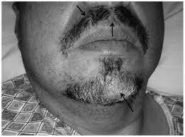 The stage describes where and how much the hodgkin lymphoma has spread in your body. Alopecia Areata As A Paraneoplastic Syndrome Of Hodgkin S Lymphoma A Case Report