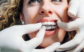 Top Invisalign® in Miami Lakes FL • All Dental Group