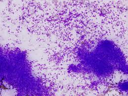 Demographic and clinical data, the cytology findings, and results of ancillary testing were reviewed. Pathology Outlines Case Of The Week 414
