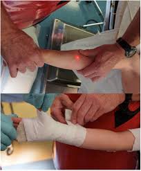 Image result for Long Arm Cast