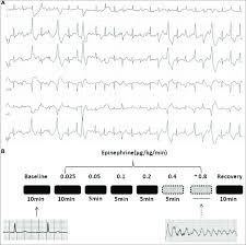 Image result for Exercise Induced Syncope