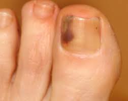 Some doctors say nail melanoma often develops on the thumb of one's dominant hand, or big toe of one's dominant side. 37 Cancer Symptom Toenail Background