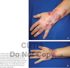 Image result for Neurotic Excoriation